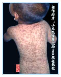 银翘散 祖传秘方：小儿风疹强效验方芦根银翘散