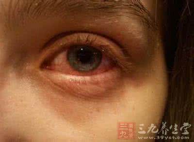 结膜炎多久能好 结膜炎传染吗