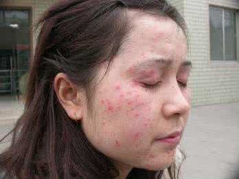 面部过敏性皮炎的治疗 过敏性皮炎如何治疗 这方法治疗过敏性皮炎