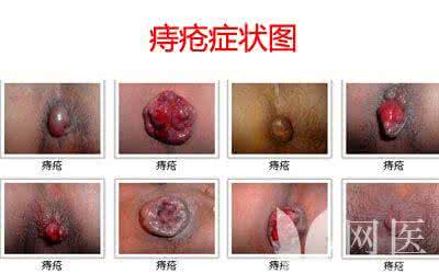 痔疮日常护理 女性痔疮初期症状 了解痔疮初期症状 做好日常护理