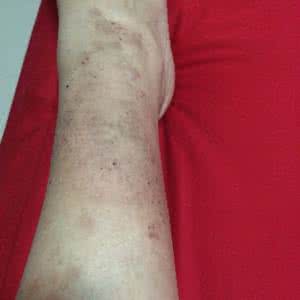 孕妇湿疹如何处理 孕妇得了湿疹怎么办 怎么处理孕妇湿疹