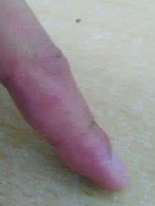 艾滋病初期症状时间 艾滋病初期症状 艾滋病初期症状时间