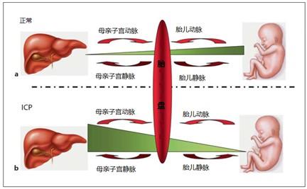 妊娠期肝内胆汁淤积症 妊娠期肝内胆汁淤积症诊疗方法