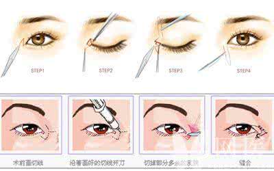 开眼角手术有几种方法 开眼角手术方法 开眼角手术方法的五种方法