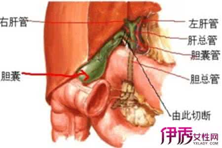 胆囊切除后遗症 胆囊切除后遗症 胆囊切除后遗症 它是如何发生的