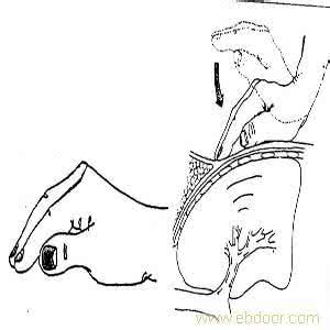 重症肌无力偏方 重症肌无力治疗偏方 重症肌无力的偏方