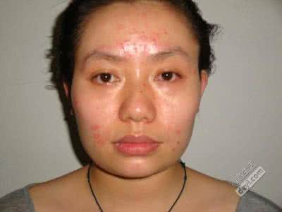 怎样去额头上的痘痘 具体该怎么做