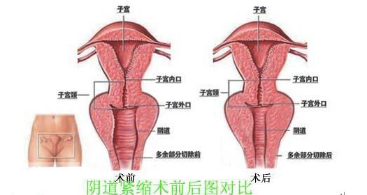 阴道紧缩术的手术方法 阴道整形手术的方法