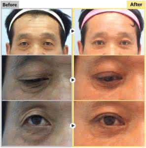 男性眼部整形 男性眼部整形 男性眼部整形怎么整？