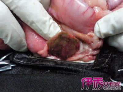 胃穿孔的症状 胃穿孔症状 胃穿孔症状 胃穿孔的3个症状