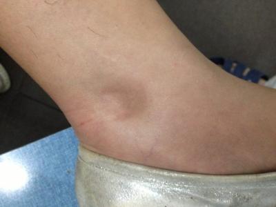 美女四肢可拧麻花 马老师治疗妊娠肢麻验案一则