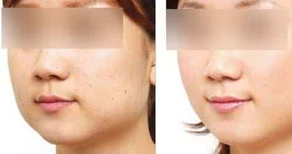 黑脸娃娃去痘印效果 黑脸娃娃去痘印效果 黑脸娃娃去痘印