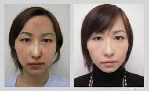 简单有效的祛斑方法 简单有效祛斑 祛斑效果最好的6大简单方法,不收藏可惜了!!
