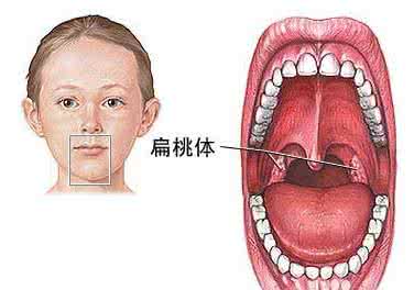 扁桃体炎是什么原因 扁桃体炎是什么原因 引发扁桃体炎的九大原因