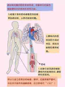 肺动脉栓塞怎么治疗 “坐”出来的肺动脉栓塞