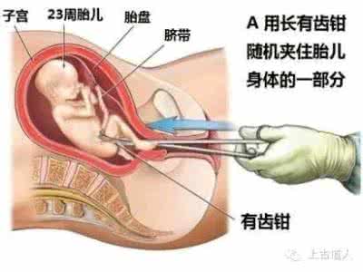 药流最多多少钱 女人最多能够承受几次流产手术：药流适用范围较小