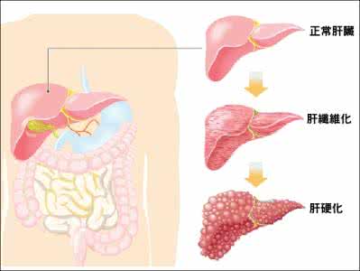 肝炎和肝硬化的区别 肝硬化 什么叫肝炎？