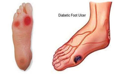 糖尿病足的临床表现 糖尿病足临床表现 当你有这几种表现，小心是糖尿病足！