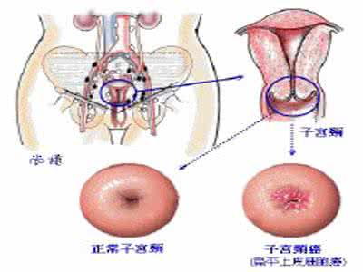 子宫肌瘤早期症状 子宫积瘤早期症状是什么