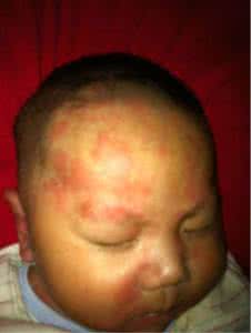 脸部过敏一般几天会好 过敏总是反复 脸总是反复过敏会好吗？