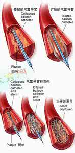 心肌梗死治疗措施 心肌梗死的治疗