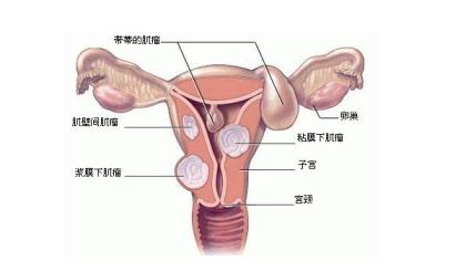 治疗子宫肌瘤的中医院 治疗子宫肌瘤 中医敷贴法治疗子宫肌瘤