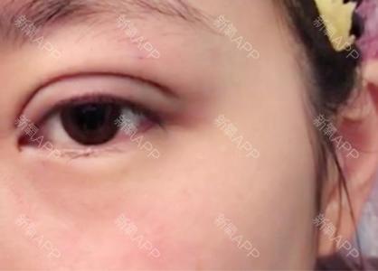 做双眼皮手术冰敷几天 埋线双眼皮怎样冰敷?