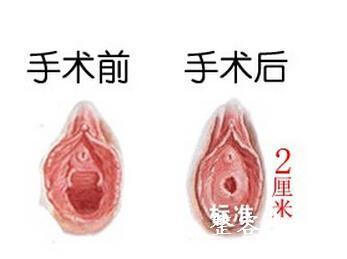 青瓷数码技术 处女膜修复术注意事项 青瓷的修复方法及注意事项