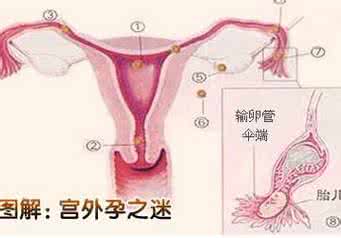 宫外孕早期症状 试纸 宫外孕前兆有什么反应 宫外孕的症状是