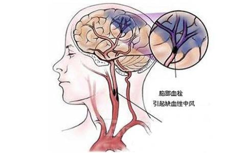脑梗塞 有没有脑梗，画个圈就知道！这一味专破脑梗，非常了得！