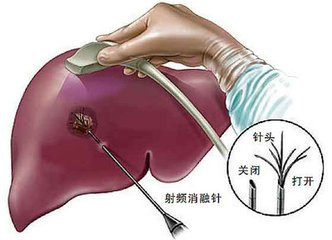 大肠癌肝转移 大肠癌肝转移怎么治？救命！