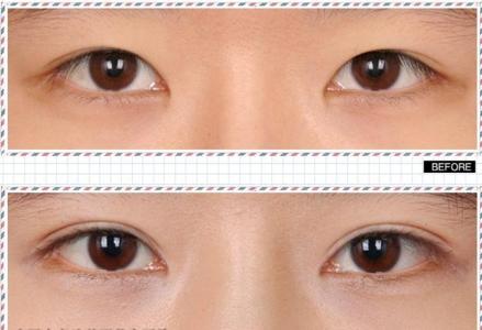 眼部整形美容手术图谱 眼部整形美容手术是怎么做的?