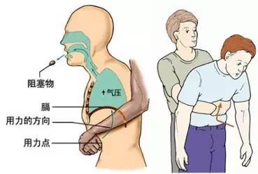 鱼刺卡在喉咙不取出 鱼刺卡在喉咙不取出 喉咙里有东西怎么取？