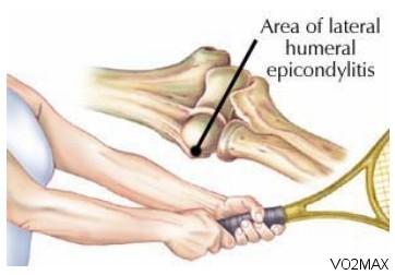网球肘运动 网球肘的运动康复