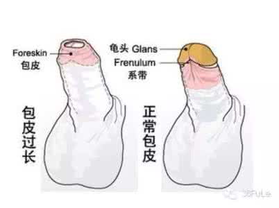 男性假性包皮过长影响早泄吗