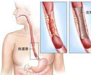 食道癌早期症状 辨别食道癌的5个早期症状