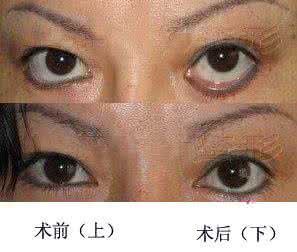 睑外翻矫正术 睑外翻矫正术视频 下睑外翻矫正术