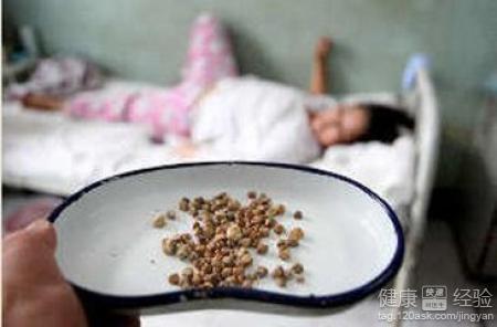 胆结石吃什么药 胆结石吃什么药 如何治疗胆结石