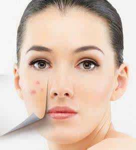 粉刺怎么去除小妙招 粉刺怎么去除小妙招 可以减压的小妙招