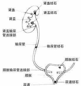 肾结石自然疗法 肾结石自然疗法介绍【图】