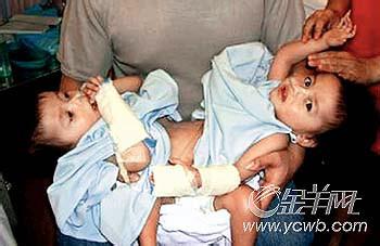 鼻尖缩小整形 湖南3岁女孩成功接受“全脑缩小整形”手术