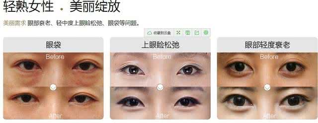 眼部整形美容手术图谱 眼部整形美容手术图谱 常见的几种眼部整形美容手术