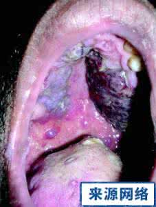艾滋病口腔症状 艾滋病口腔症状 艾滋口腔症状会痛吗?