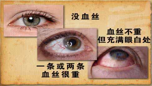 眼底充血是怎么回事 眼底充血 眼底充血是怎么回事