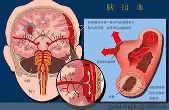 脑血栓和脑梗塞的区别 心梗?血栓???分清脑出血?脑血栓?脑梗塞