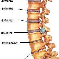 腰椎间盘膨出突出 腰椎间盘膨出，突出，腰椎管狭窄的好方子