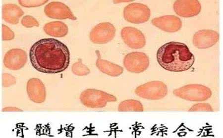 环孢菌素胶囊 环孢菌素A单独或联合沙利度胺治疗骨髓增生异常综合征