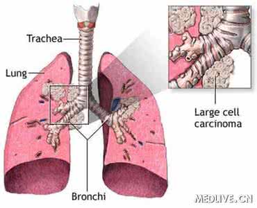 肺部肿瘤的治疗方法 肺部肿瘤的治疗方法 肺部肿瘤的治疗方法 肺部肿瘤治疗详解