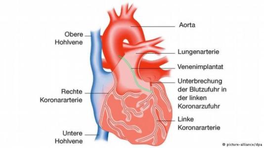 心脏搭桥术后血管通畅 20141121心脏血管通畅-防止心肌梗塞s