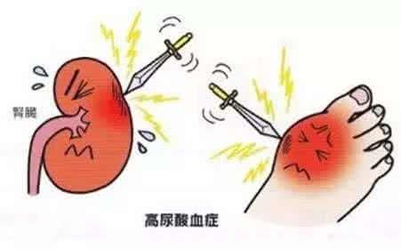 尿酸达到多少会痛风  【疾病诊疗】尿酸高于多少容易引起痛风？